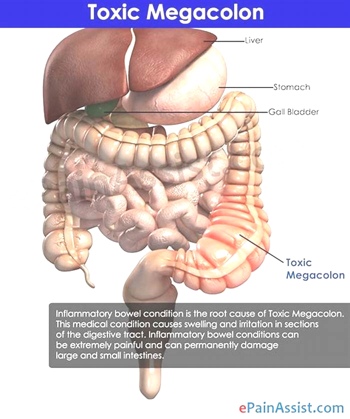 What is the primary symptom for megacolon